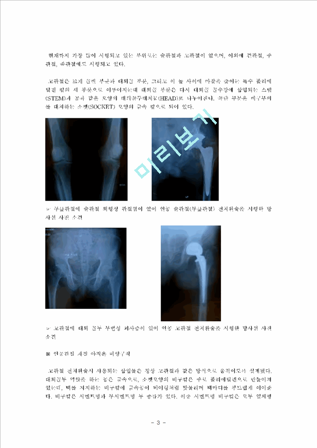 [의학,약학][의학] 고관절 전치술, 슬관절 전치술 -THR [Total Hip Replacement], TKR[Total Knee Replacement]   (3 )
